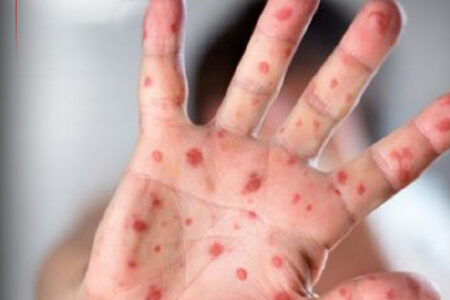 “سرخک و سرخجه” در ایران ریشه‌کن شد/ سازمان جهانی بهداشت تأیید کرد