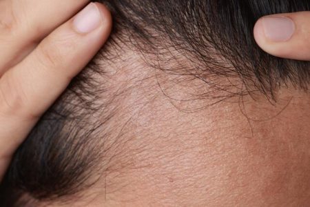 ۶ دلیل که سبب ریزش موها می‌شود.