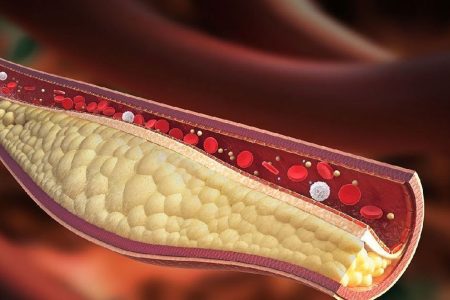 افراد شب بیدار بیشتر در معرض سخت شدن شریان ها قرار دارند.