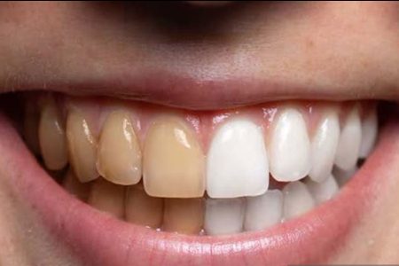 یک متخصص بیماری‌های لثه گفت: جرم‌گیری هیچ اثر منفی بر مینا و ریشه دندان‌ها ندارد.