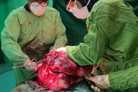 خارج‌کردن ‌تومور ۱۱ کیلویی از شکم بیمار در بیمارستان گراش