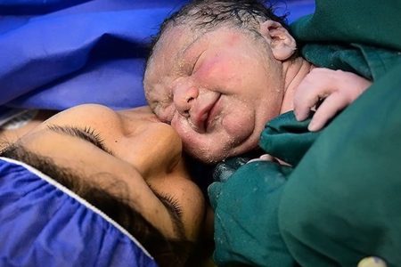 تمایل بالای مادران به زایمان سزارین در ایران: غفلت از توسعه زایمان بدون درد و خطرات پنهان